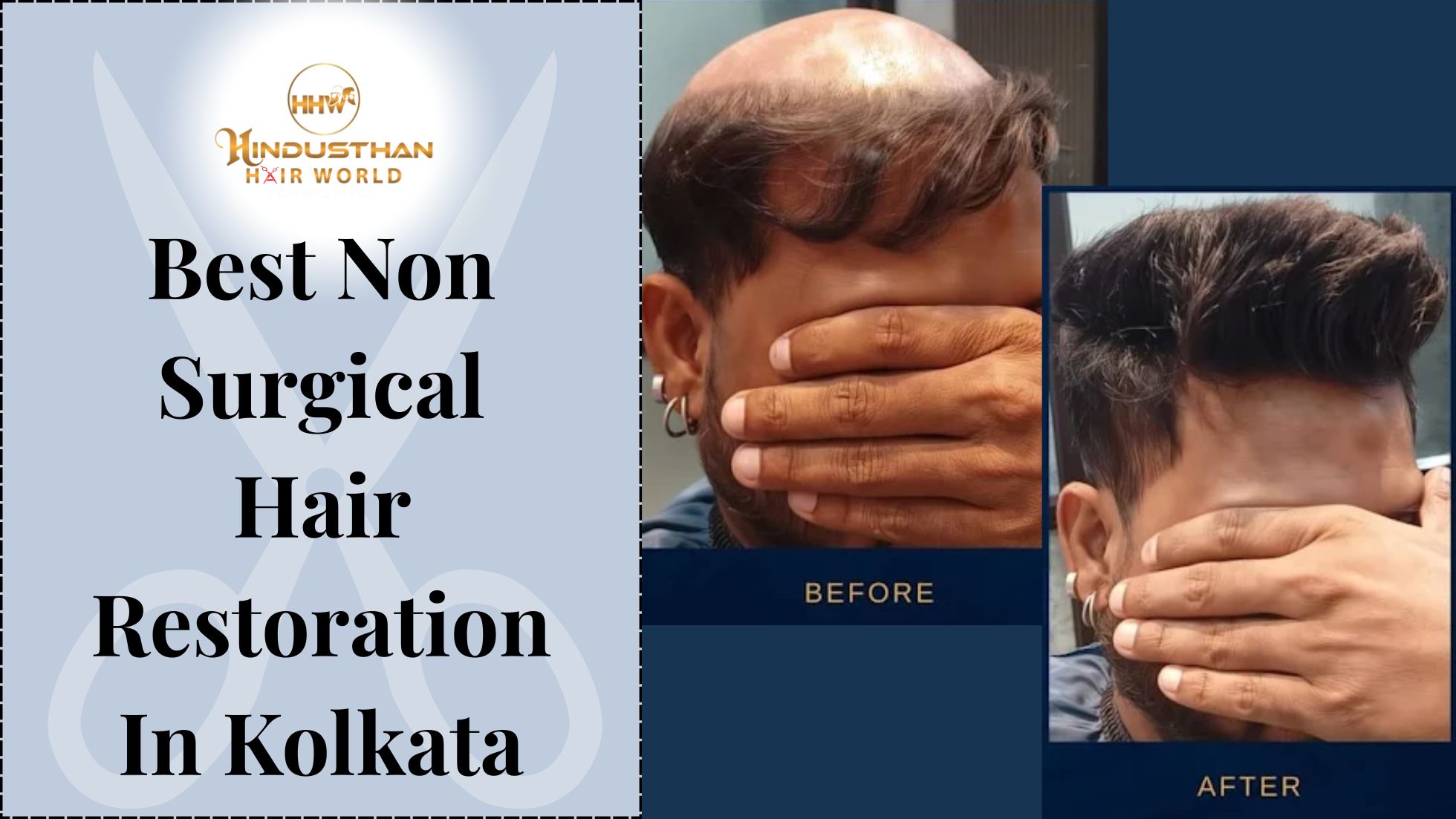 Best Non Surgical Hair Restoration In Kolkata for You!