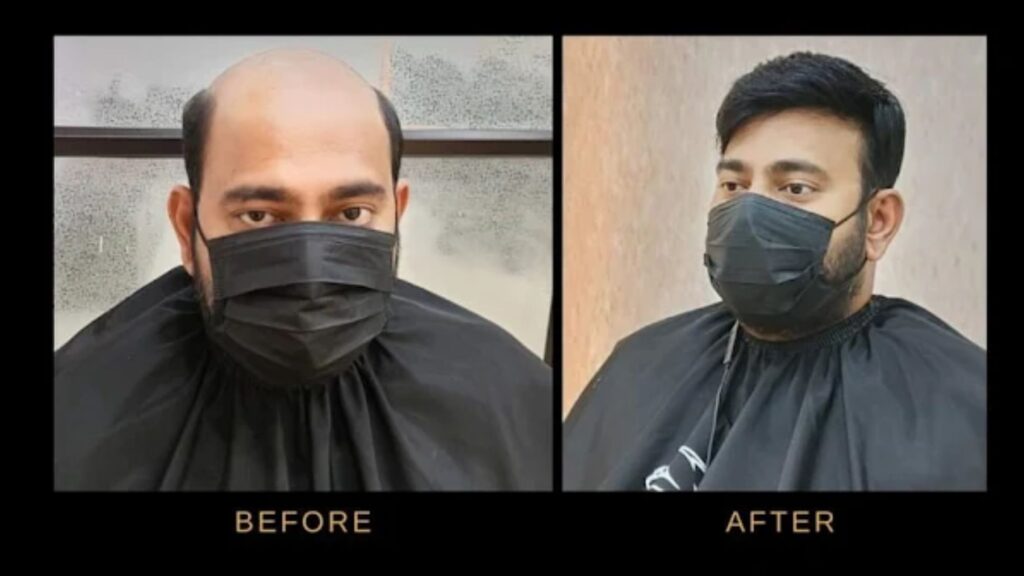 Best Hair Patch centre in Kolkata: Instantly Enhance Your Appearance Through the Non-Surgical Method