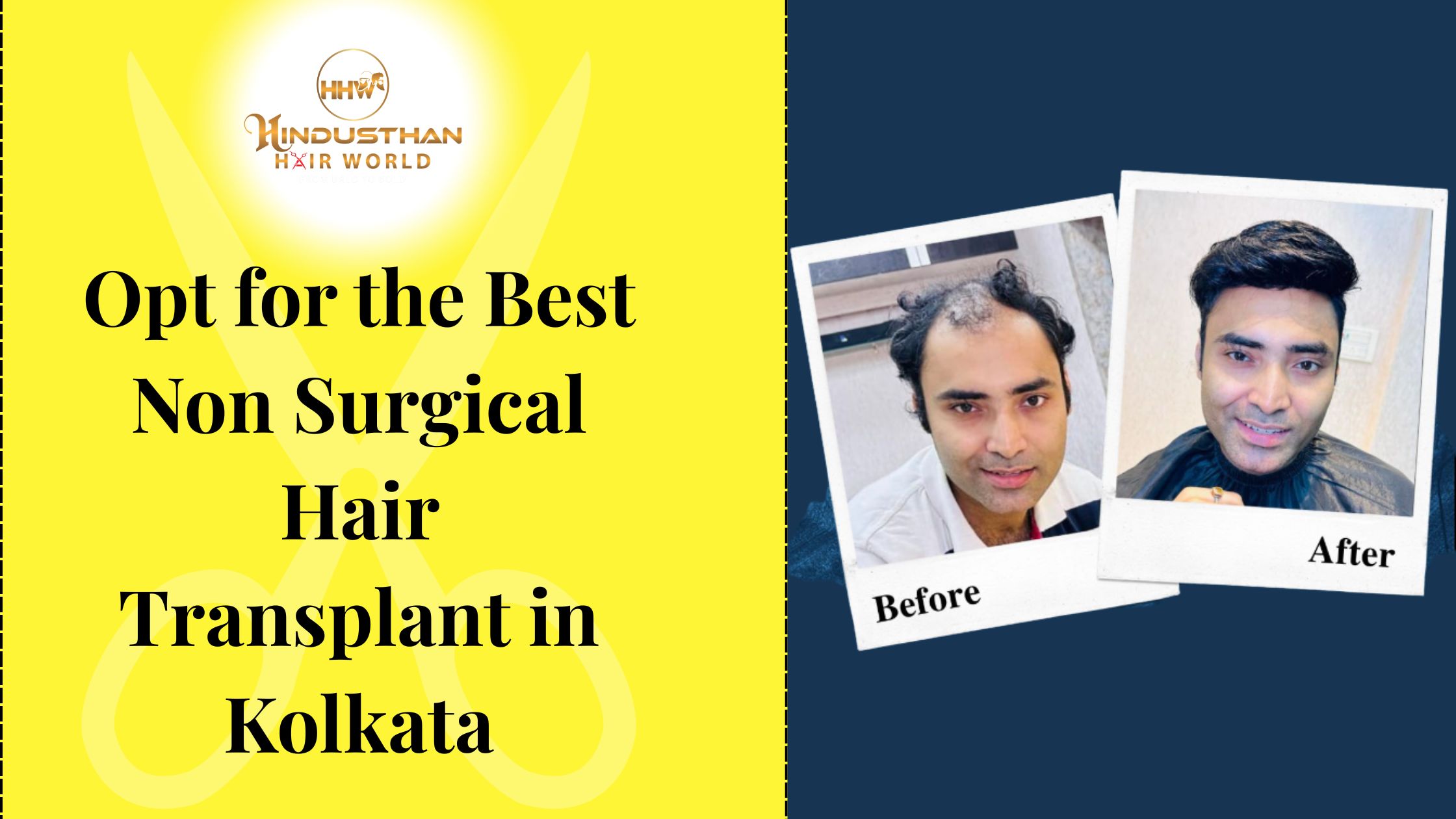 Best Non Surgical Hair Transplant in Kolkata to Restore Youth!