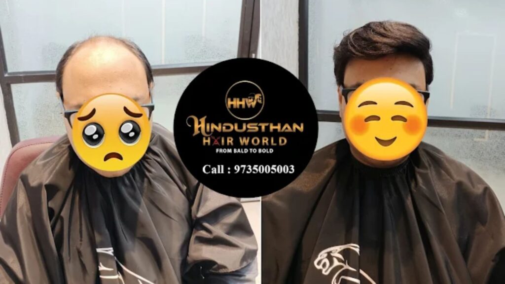 Non Surgical Hair Restoration in Kolkata Gives You Immediate Results