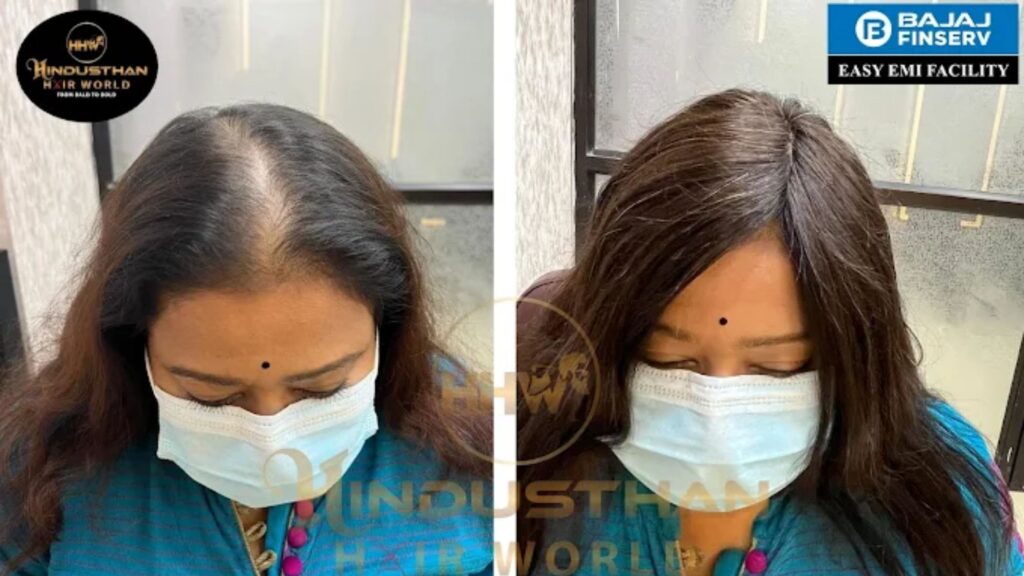Non Surgical Hair Transplant in Kolkata Buffs Your Looks
