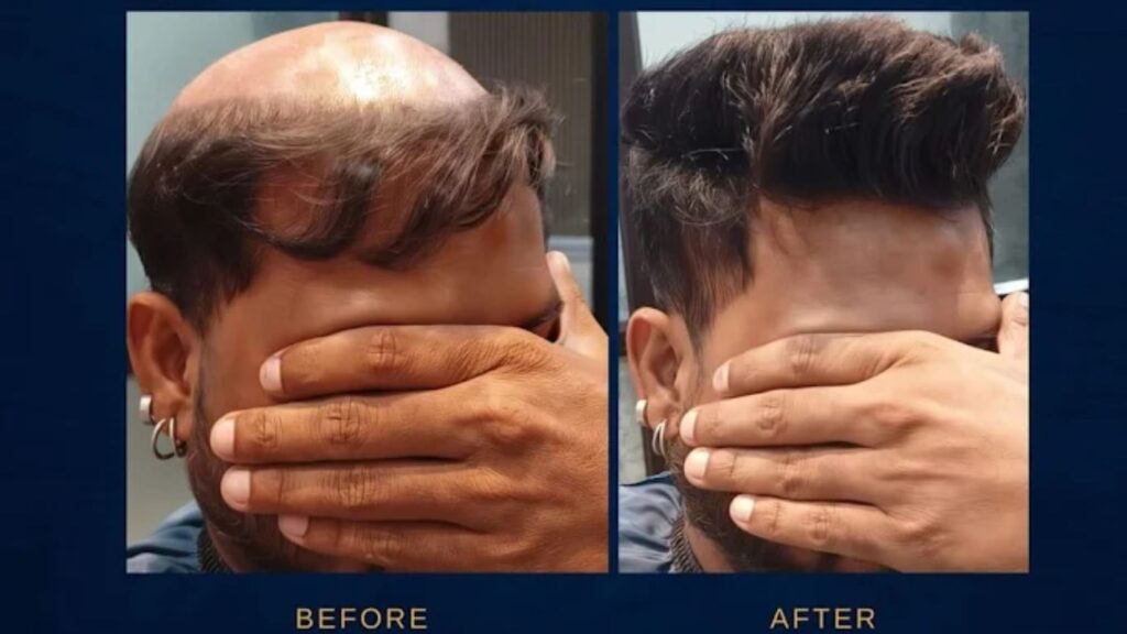 Why Choose Hindustan Hair World for the Best Non Surgical Hair Restoration in Kolkata?