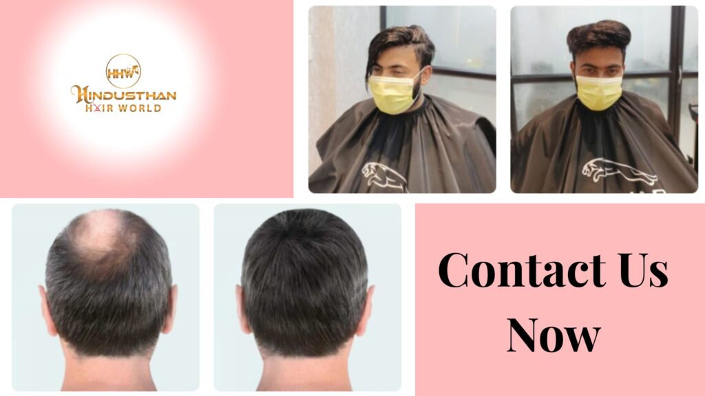 What are the Benefits of a Non-Surgical Hair Replacement Service in Kolkata